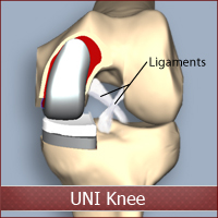 UNI Knee Replacement